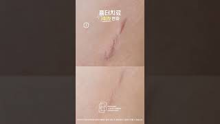 안 지워지던 흉터가 이렇게까지 지워진다?!