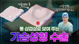 직접 보고 결정하세요! 통 삼겹살과 4K 내시경으로 보는 내 몸속 가슴 성형 과정